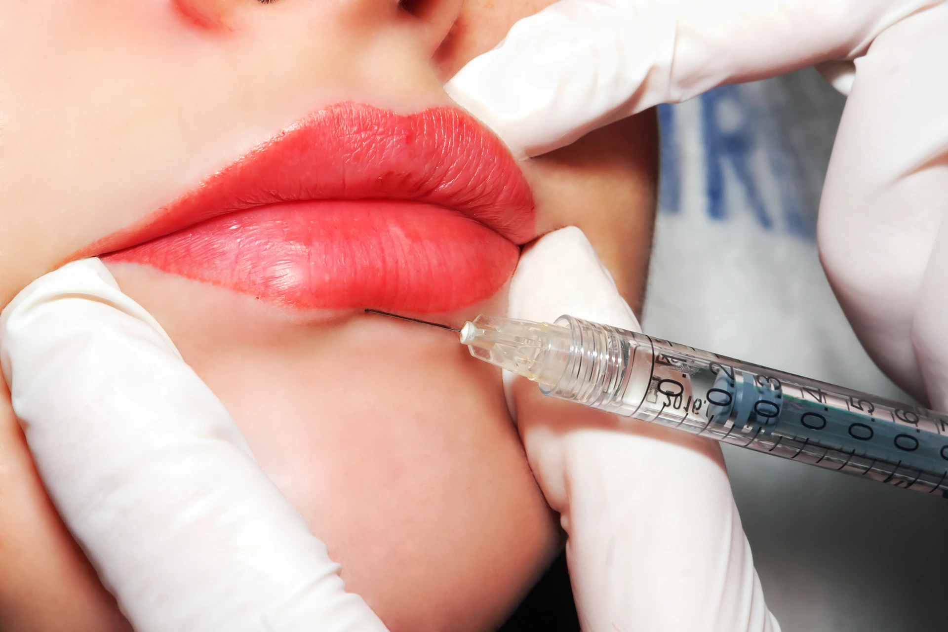 https://lipfillernearme.co.uk/ Lip Fillers Near Me